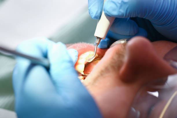 Best Emergency Tooth Extraction in Edwards Af, CA