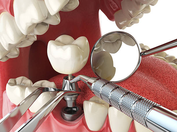 Best Emergency Tooth Extraction in Edwards Af, CA